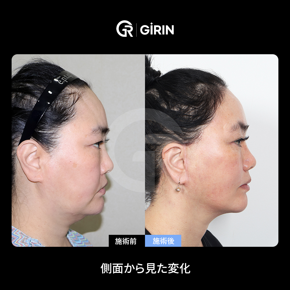 ミニフェイスリフトとフルフェイスリフトの価格差
