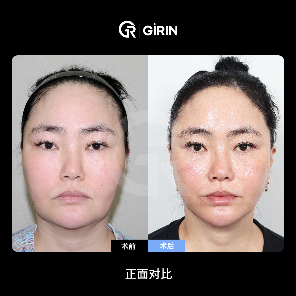 面部老化的结构性原因解析