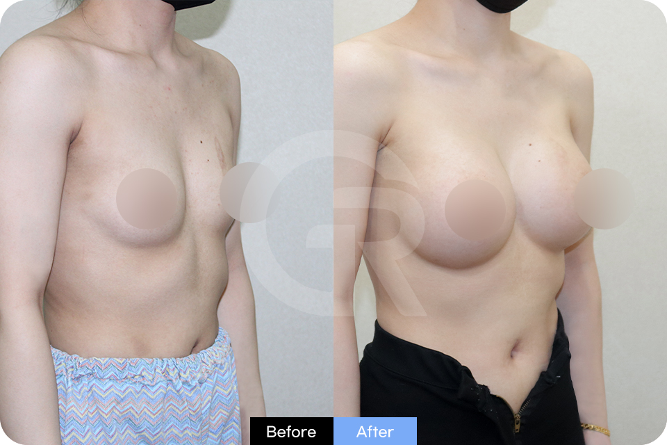 Girin Plastic Surgery Korea Breast Augmentation case 03 Half Side