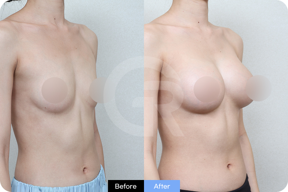 Girin Plastic Surgery Korea Breast Augmentation case 02 Half Side