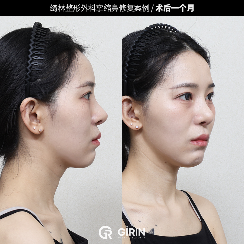 自然和谐的鼻部线条设计