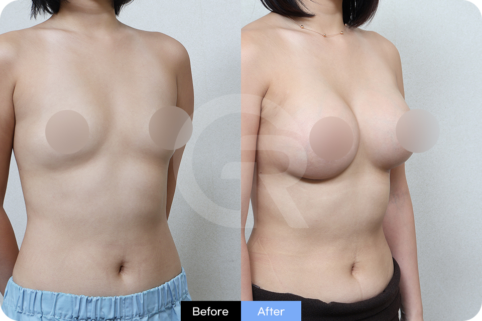 Girin Plastic Surgery Korea Breast Augmentation case 06 Half Side