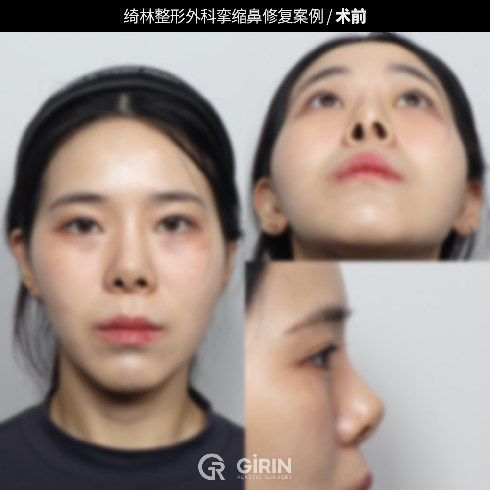 鼻整形修复手术前后对比韩国绮林整形外科短鼻再手术案例