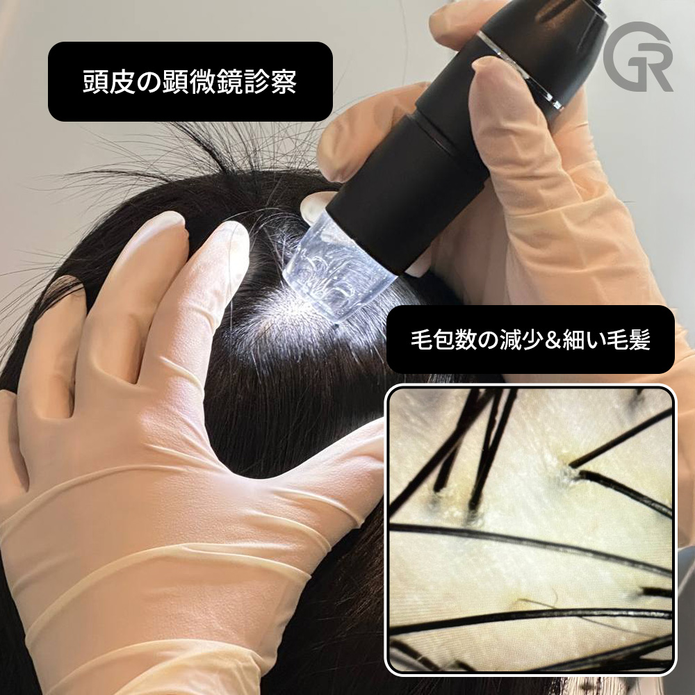 頭皮環境改善を目的とした幹細胞治療