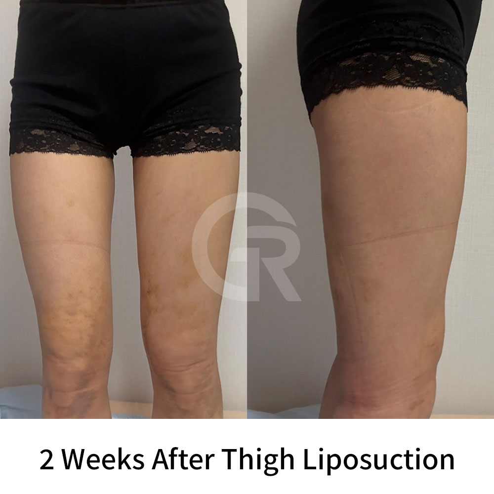 Inner thigh liposuction should be planned according to leg shape, skin elasticity, and overall proportions.