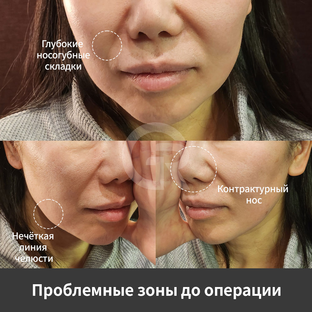 Клиника Пластической Хирургии Гирин в Каннаме, Корея, выполняет омолаживающие операции, включая мини-фейслифтинг, коррекцию морщин и провисания нижней части лица.