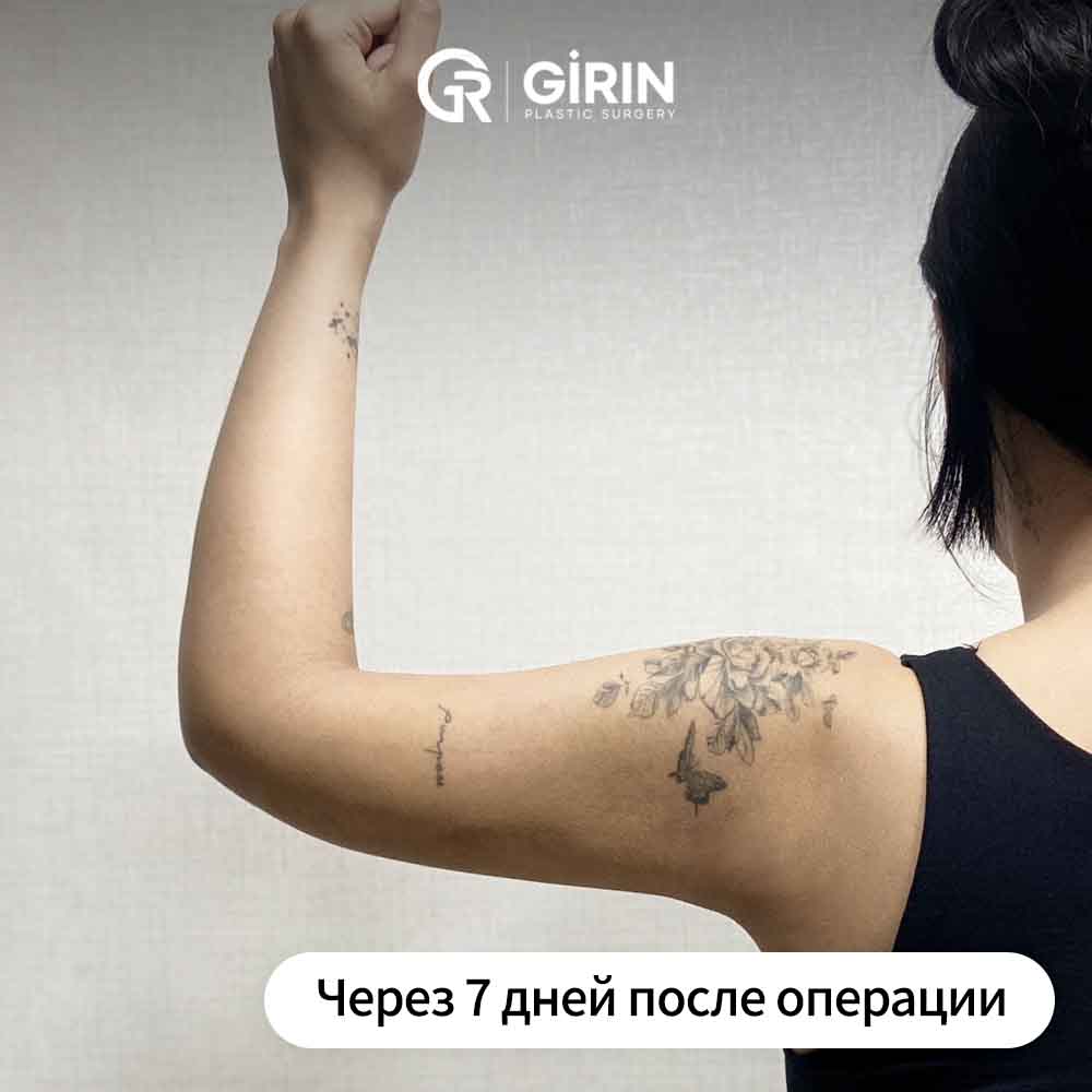 Фиброзный жир в зоне рук — индивидуальный подход