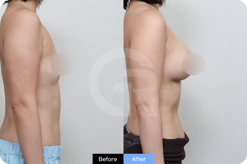 Girin Plastic Surgery Korea Breast Augmentation case 06 Side
