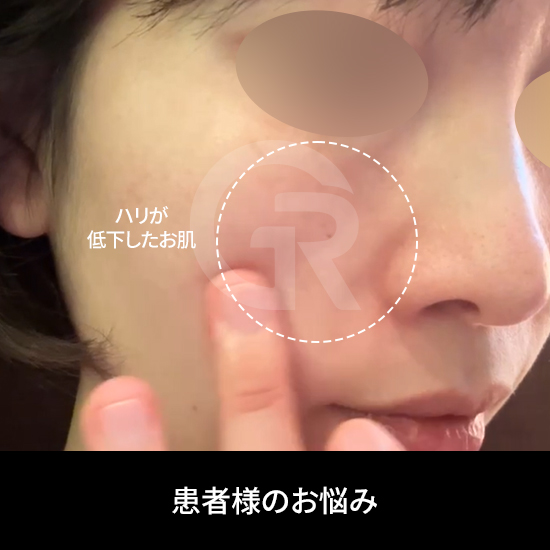 コラーゲンは毛穴構造を支え、肌の密度を保つ重要な要素です。