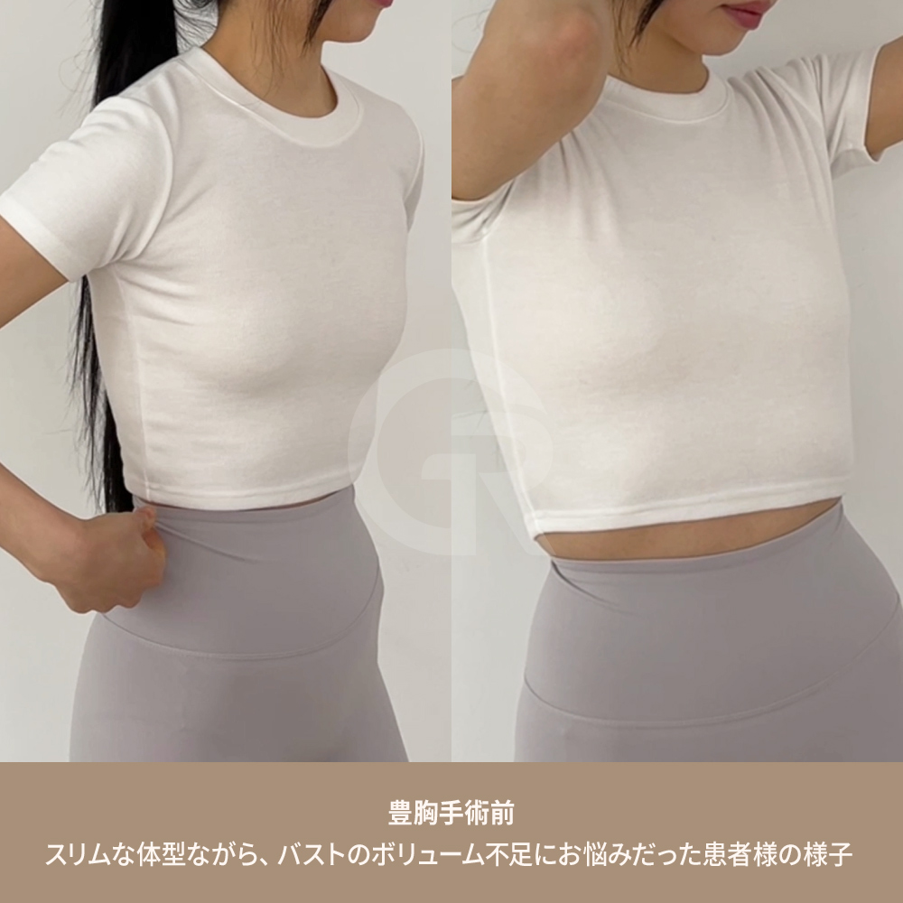 乳房の解剖構造を理解することは、安全で自然な豊胸手術を行うための重要なステップです。