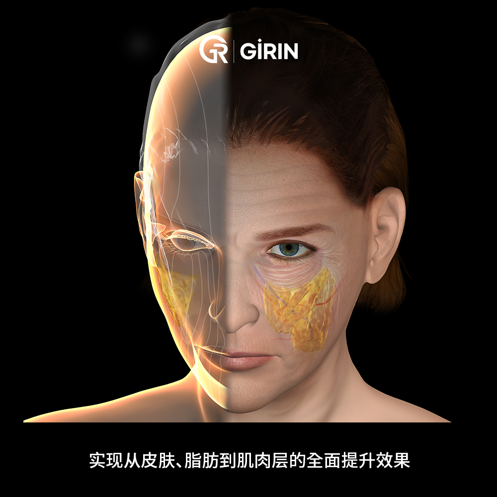 下颌线与颈部松弛的改善