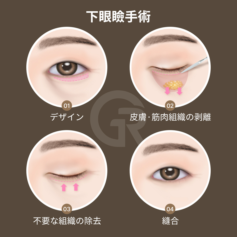 目を開けるときに額に力が入る場合、構造的なたるみの可能性があります。