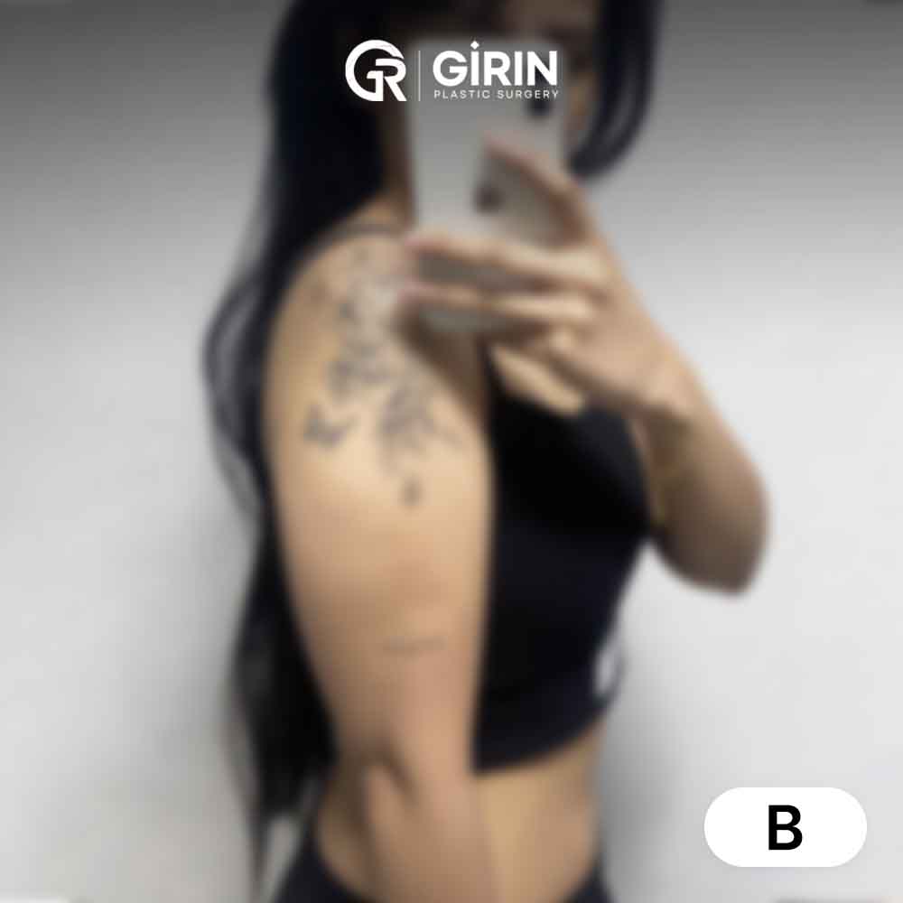 Before and after arm liposuction performed in Korea