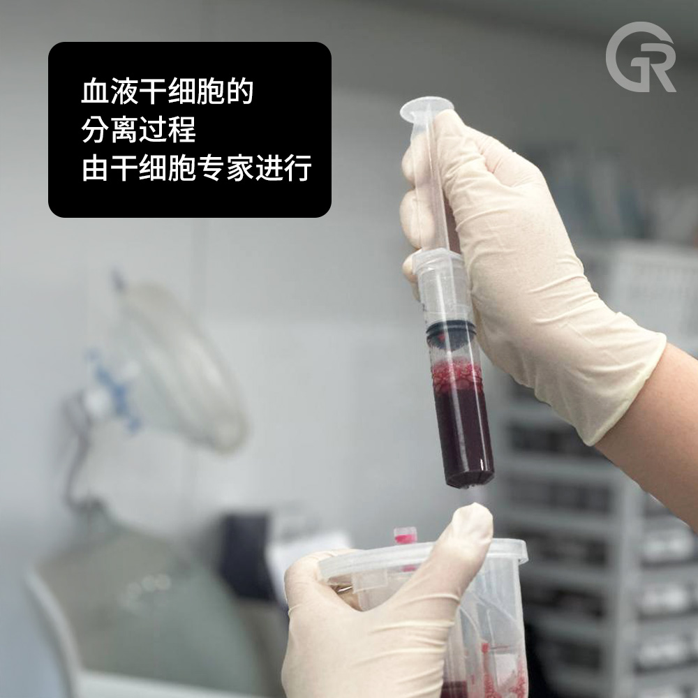 PRP与干细胞脱发治疗对比