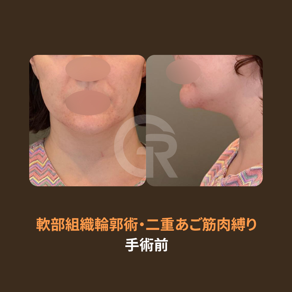 ダイエット後に顔がたるんで見える場合、減量によるボリューム変化と皮膚の余りが影響していることがあります。