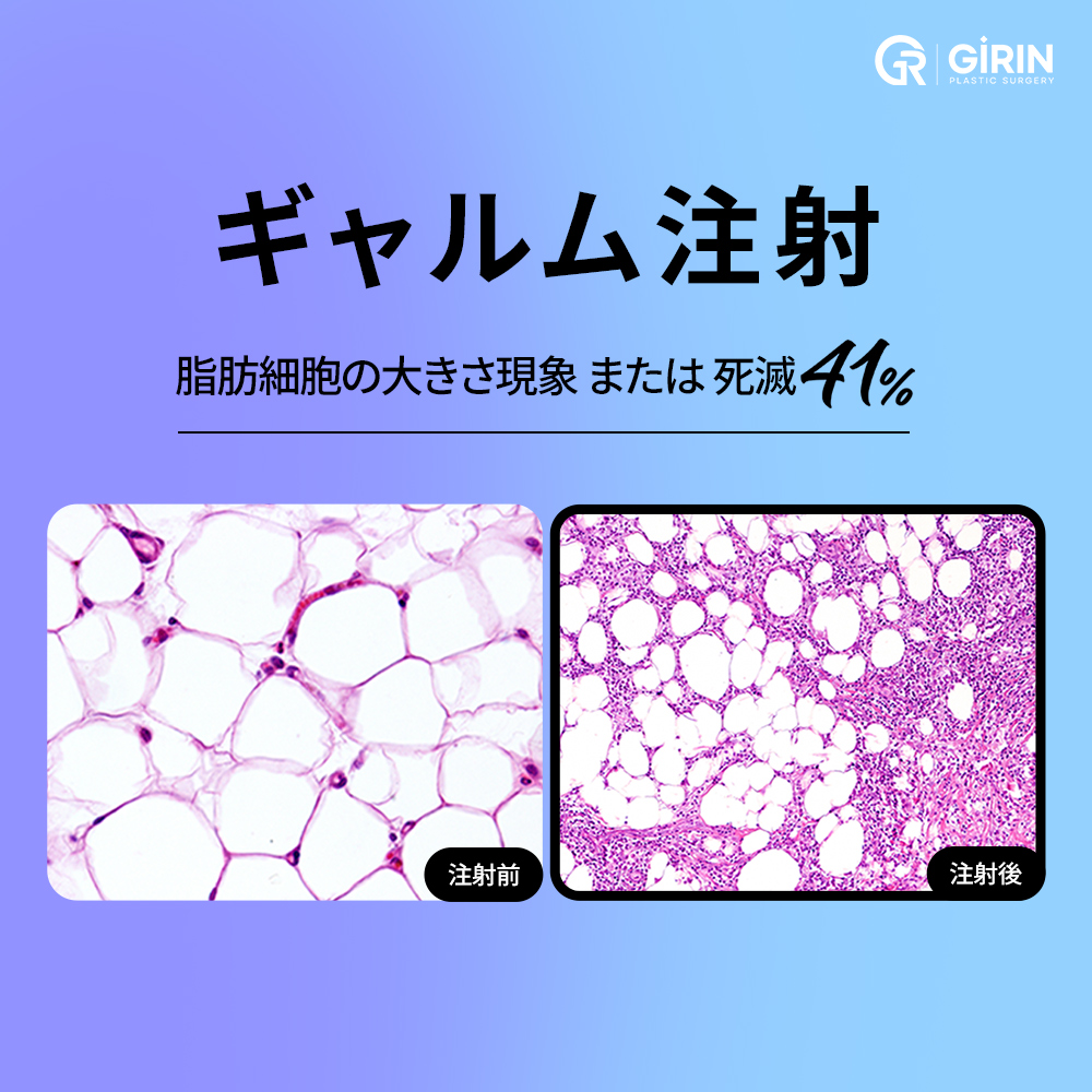 短時間で終わるノンサージカル施術