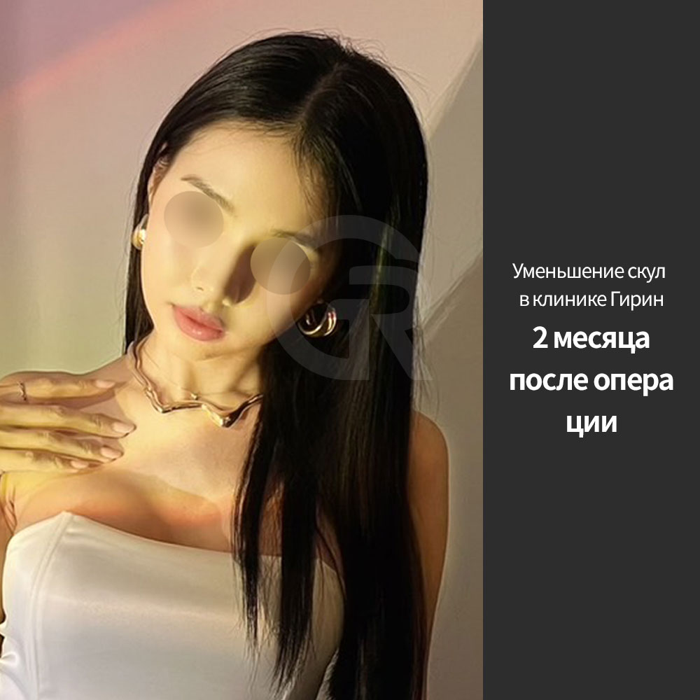 Стабильная фиксация и поддержка средней зоны лица важны для снижения риска опущения щек после операции.