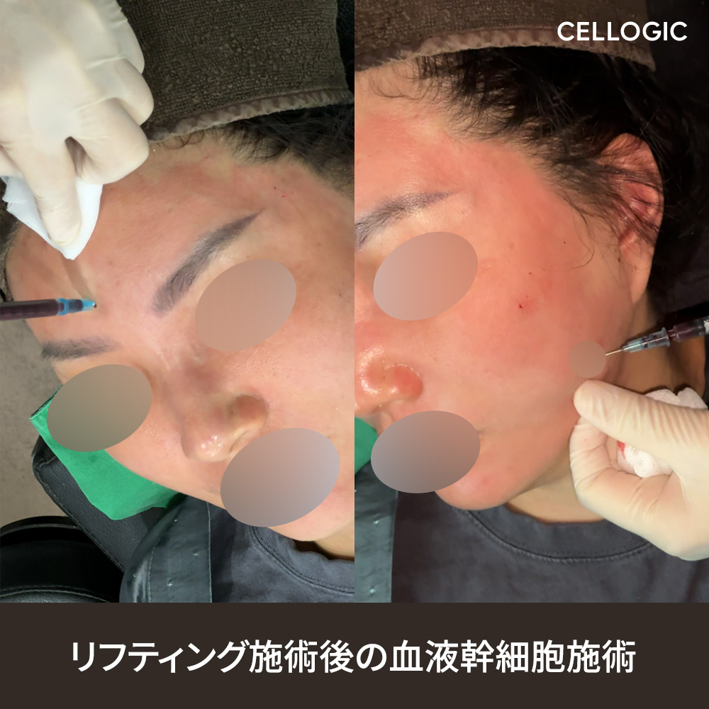 週末リフティング施術は回復期間を確保しやすく、日常生活への早い復帰を可能にします。