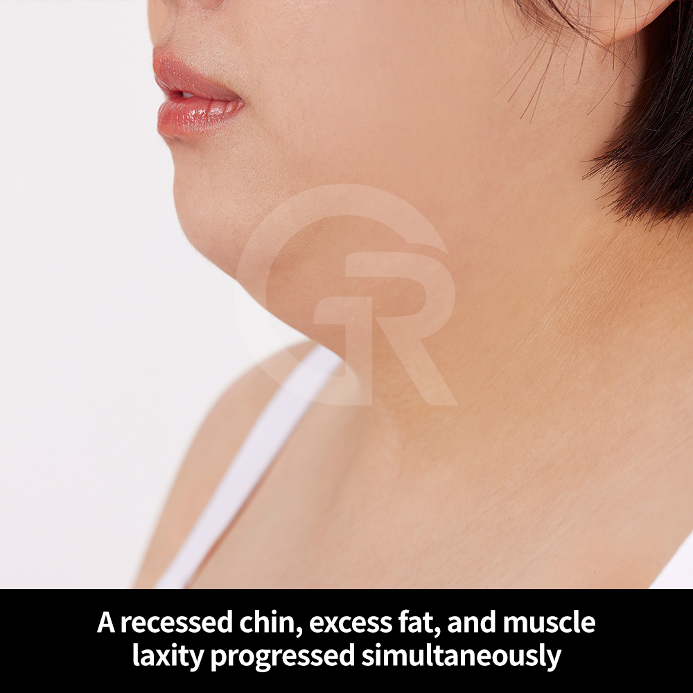 Side profile showing undefined jawline and submental fullness