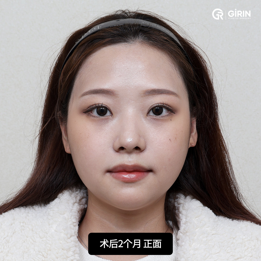 通过骨固定实现自然稳固的效果