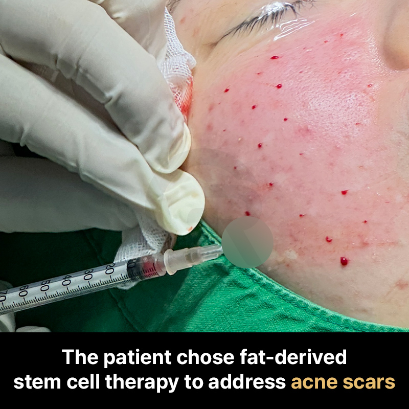 SVF therapy may be applied as an adjunctive option to support tissue recovery after surgical procedures.
