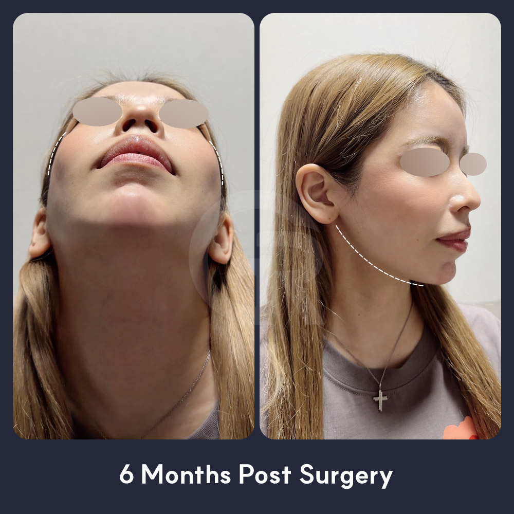Facial fat grafting after contouring surgery in Seoul can help restore volume to key areas and prevent the face from looking flat.