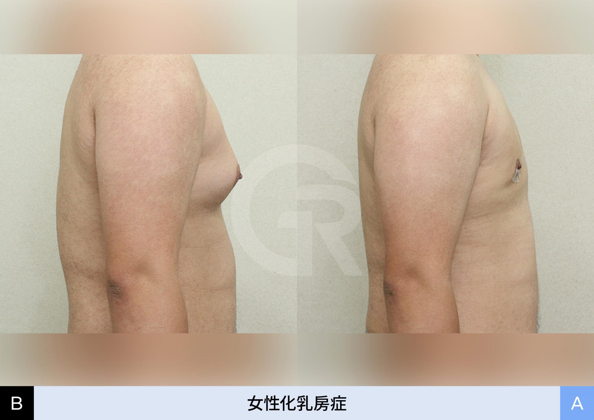男性の胸のふくらみを解消した手術結果の写真