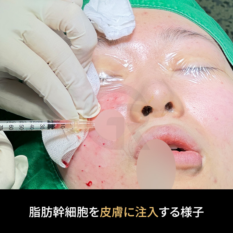 SVF療法は、患者自身の脂肪組織から抽出した細胞成分を用いる支持的アプローチです。