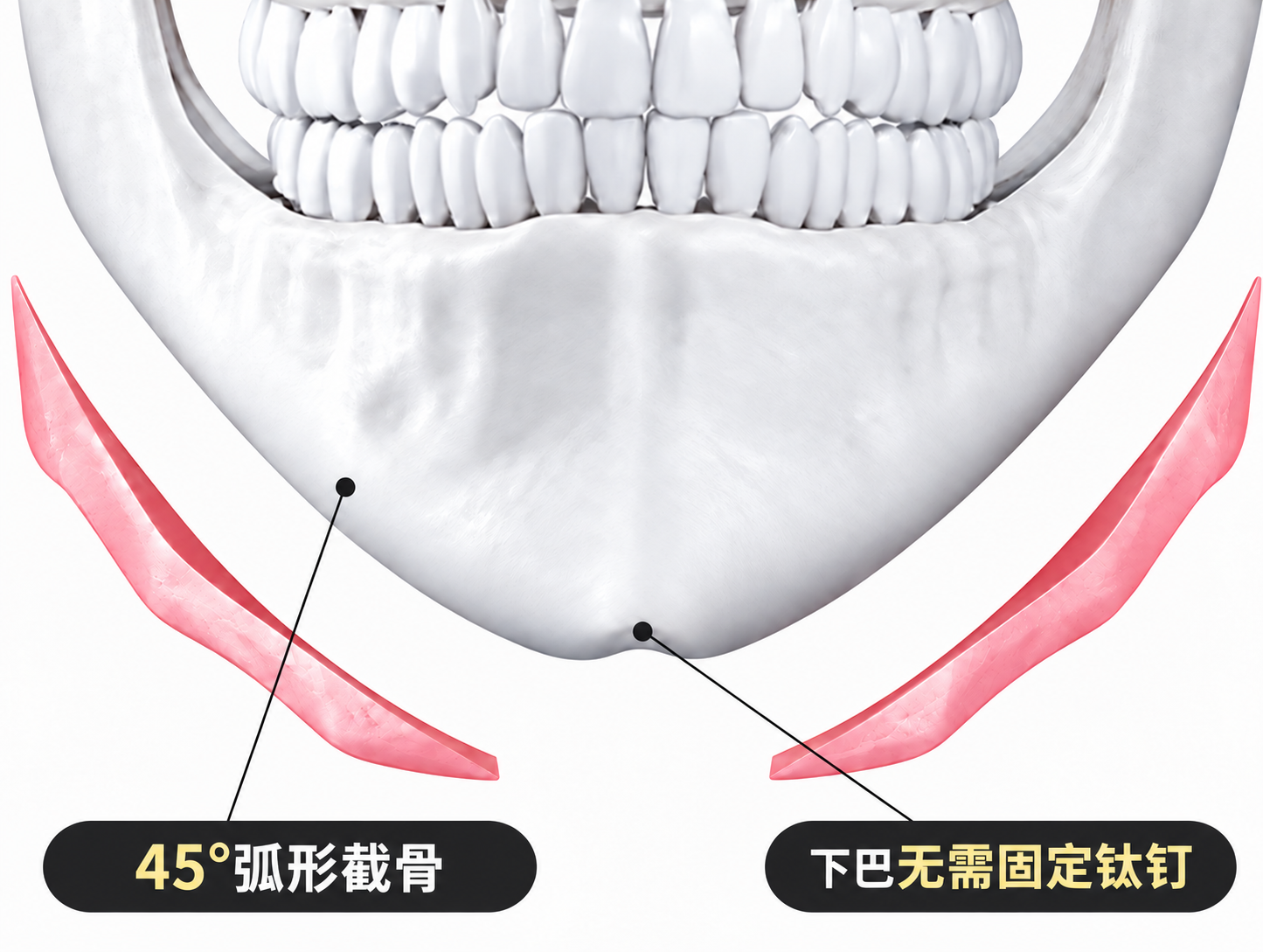 面部轮廓三件套 下巴设计 V-line脸型设计