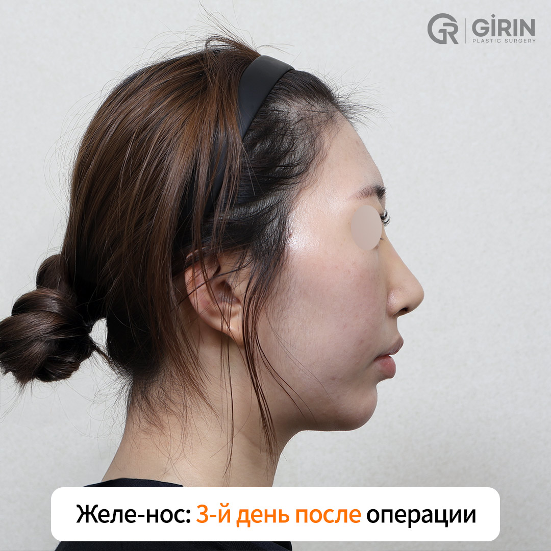 Минимальный отёк и отсутствие рубцов уже через несколько дней