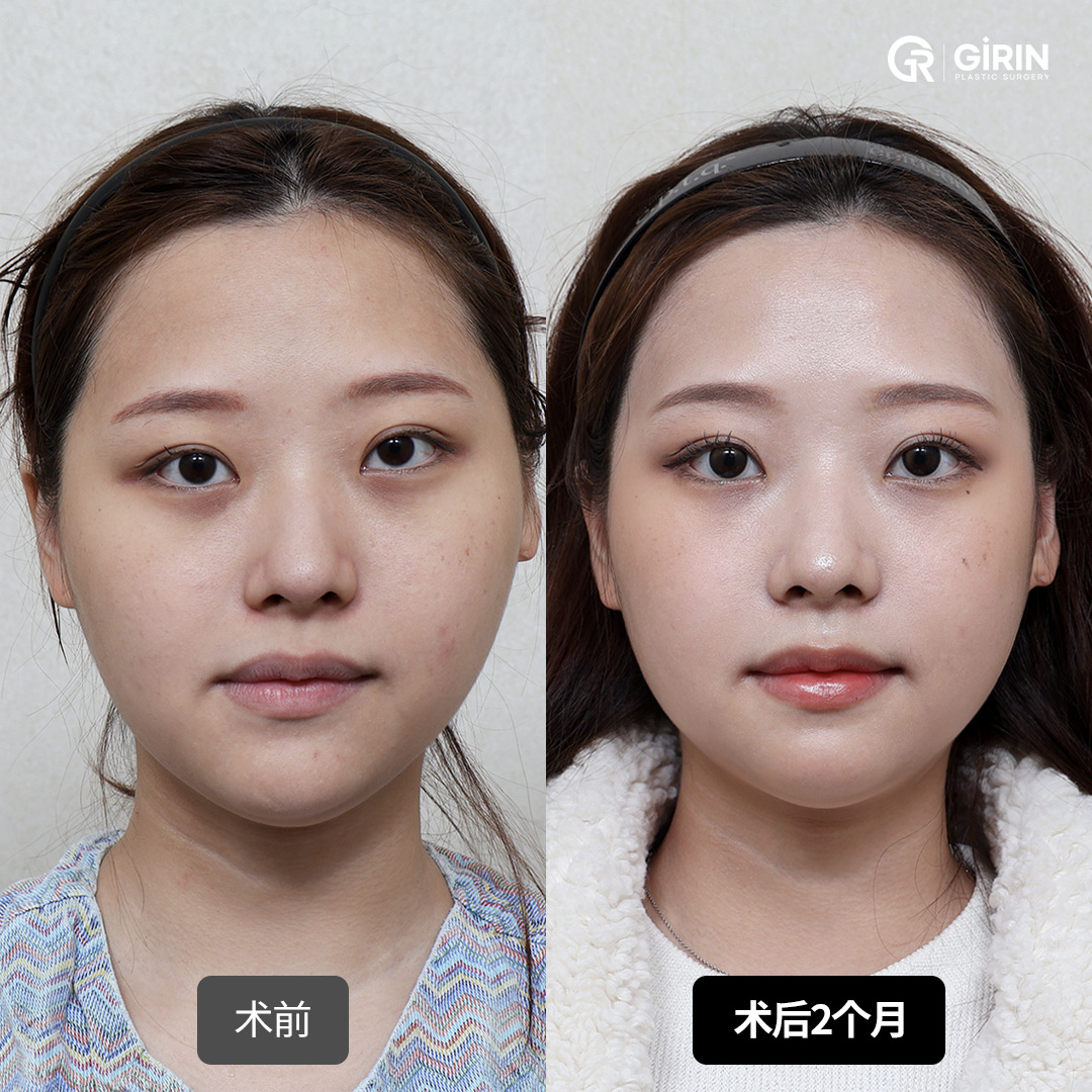 SSRO颌骨手术后的面部线条更平衡