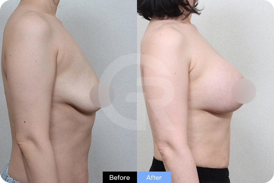 Girin Plastic Surgery Korea Breast Augmentation case 07 Side