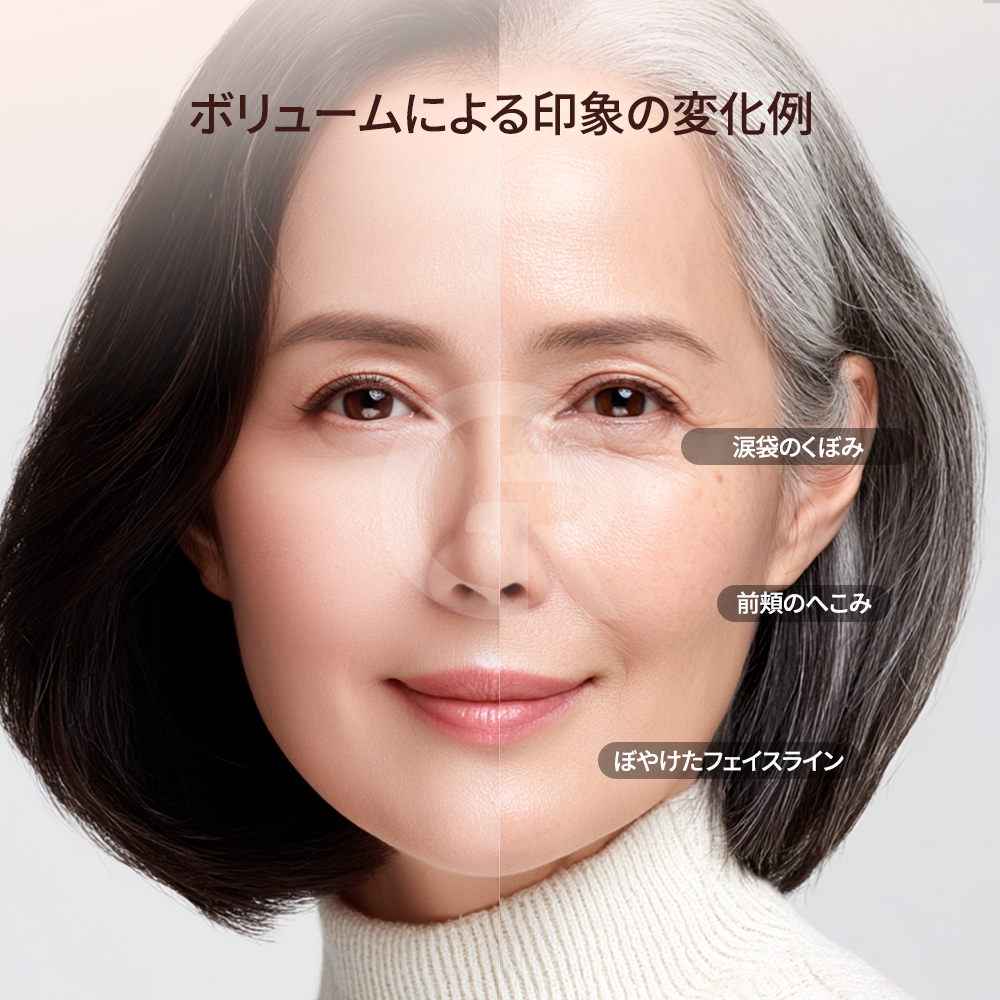 自家脂肪を使用するため、異物反応やアレルギーのリスクが相対的に低いことが特徴です。