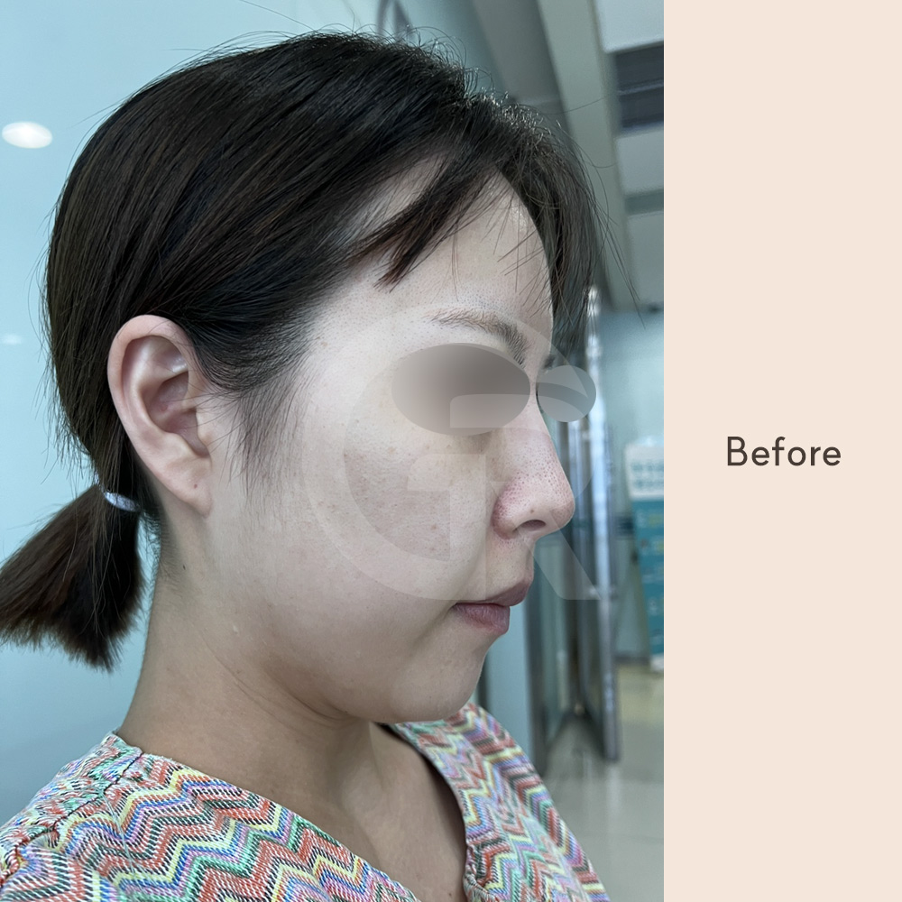 Explanation of relapse after jaw surgery, illustrating how muscle tension and soft tissue resistance can influence long-term stability if not properly controlled.