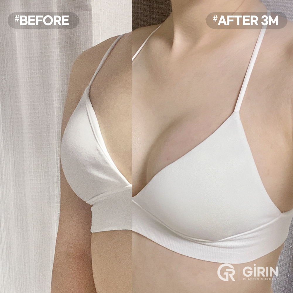 Achieve a natural, curved side profile with a balanced “UU-line” shape
