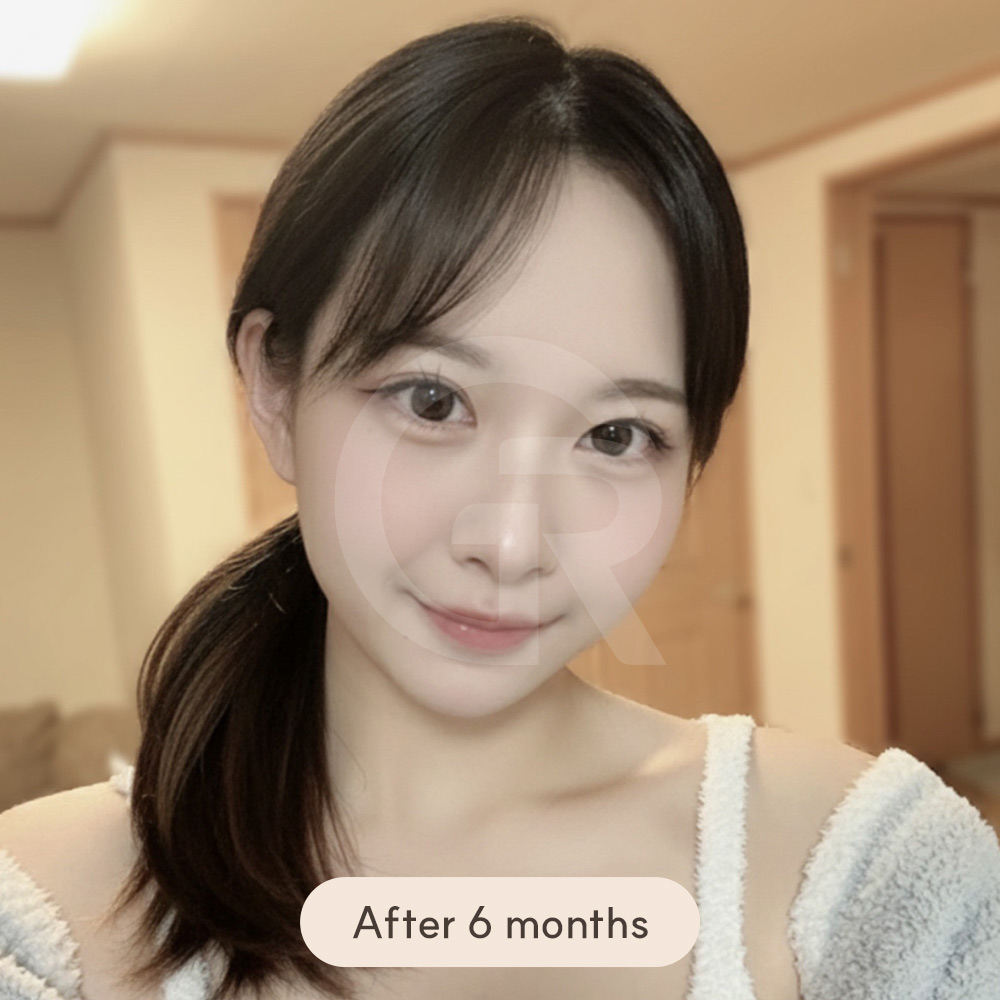 Maxilla and mandible repositioning process in orthognathic surgery, demonstrating how functional and aesthetic improvements are achieved simultaneously.