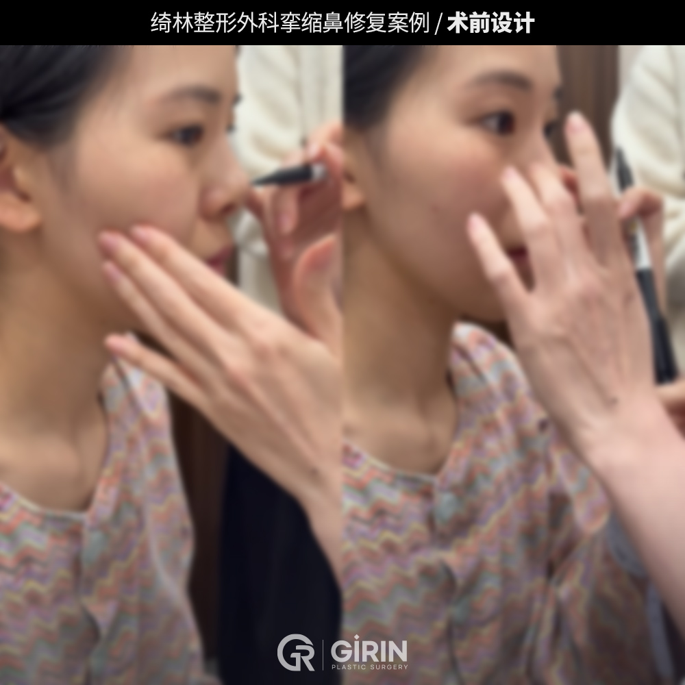 韩国知名的鼻整形专科医院——绮林