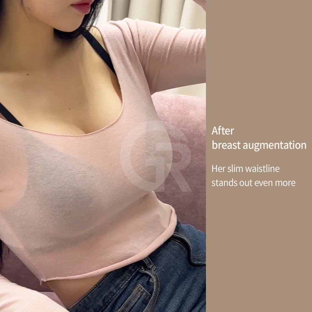 Natural breast shape after breast augmentation depends on implant selection, placement technique, and individual anatomy.