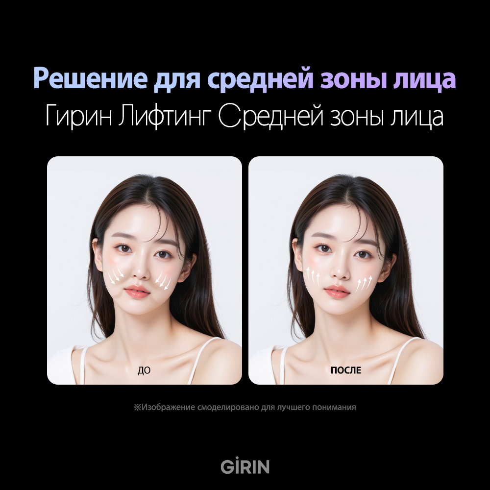 Лифтинг щёк нитями в Корее для устранения птоза средней зоны