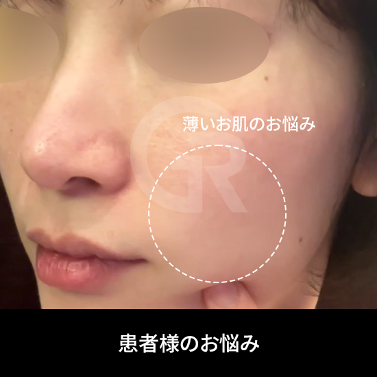 薄い肌は、支持構造の低下により毛穴が縦長に見えやすくなります。