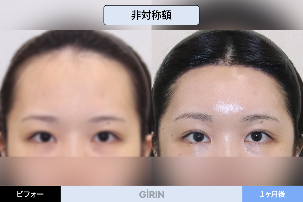 額縮小手術後の回復経過と自然に馴染むプロセス。