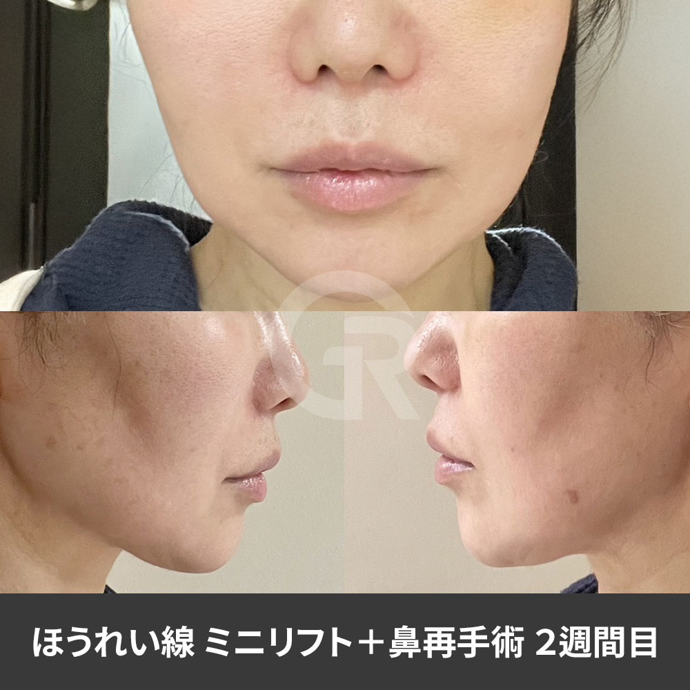 ほうれい線が深く見える原因は、皮膚だけでなく脂肪層や支持構造の変化にもあります