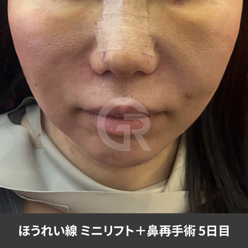 口元の重さや下頬のたるみを整えることで、疲れて見える印象の改善を目指します