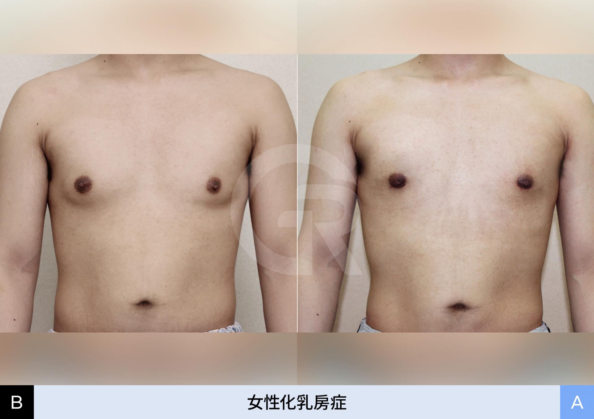 混合型女性化乳房を外科的に解決した実例