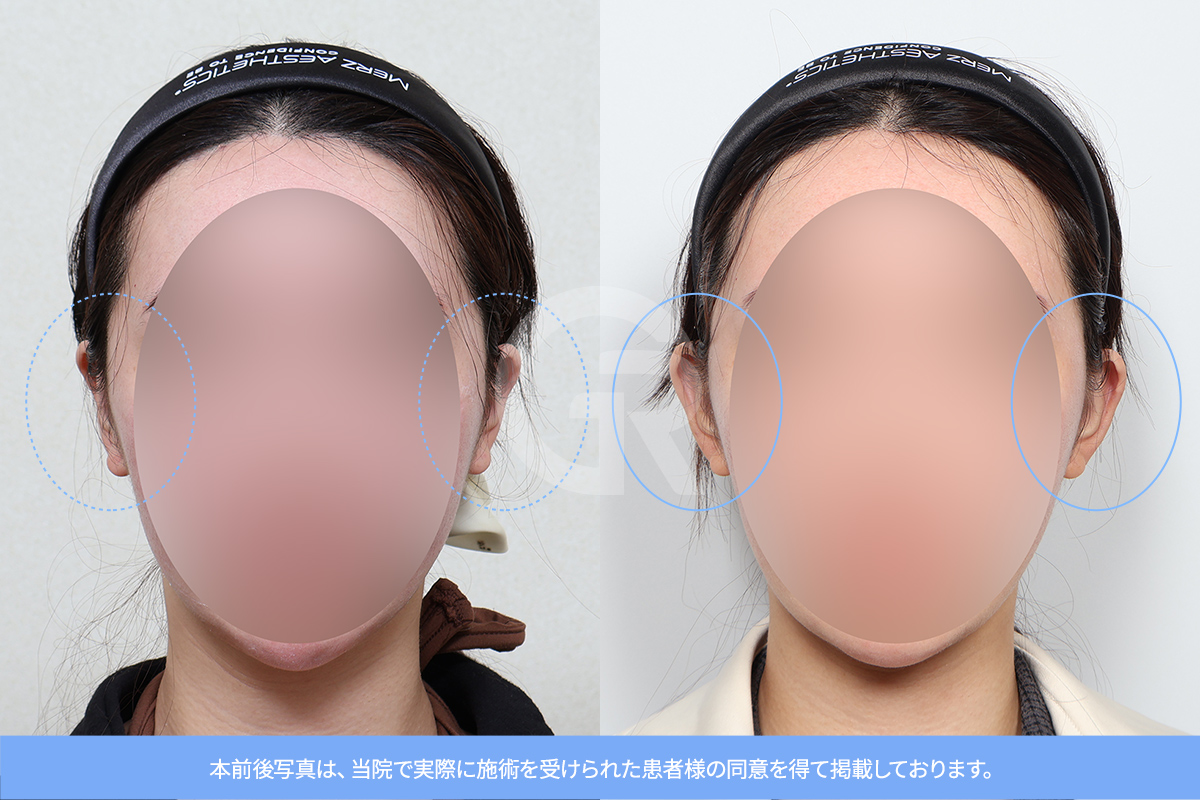 耳の軟骨を調整することで、自然で調和の取れた耳の形を作ることができます。