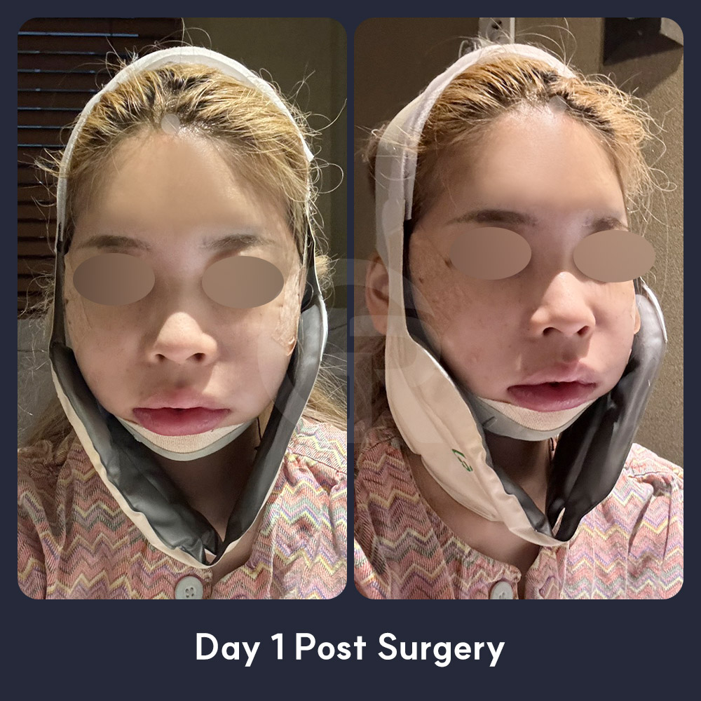 When the airway space is narrow, Girin Plastic Surgery in Seoul carefully evaluates safety before planning jaw movement surgery.