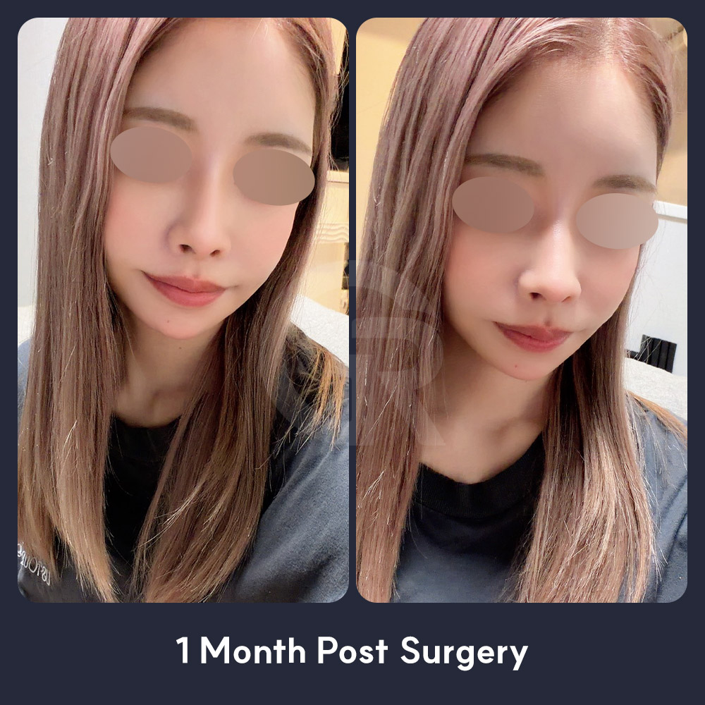 Facial contouring surgery at Girin Plastic Surgery in Korea focuses on balanced proportions within the patient’s own facial structure, not excessive bone reduction.