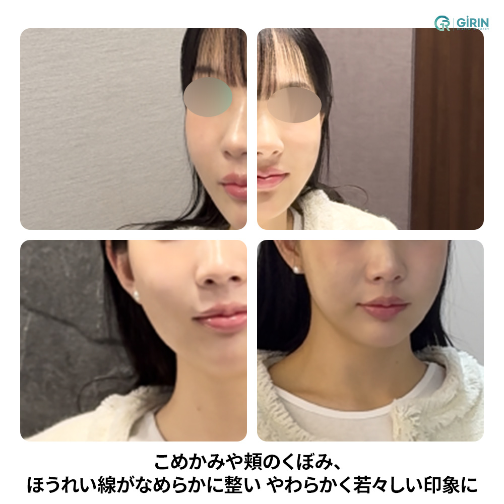 側頬のくぼみは、顔の凹凸感を強調させるポイント——丁寧に微調整。