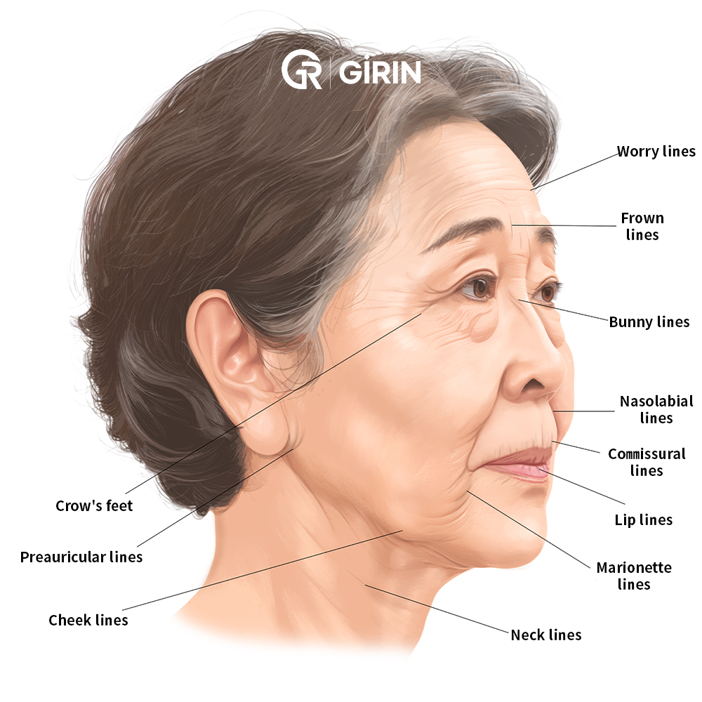 Full facelift surgery addressing skin and SMAS layer in Korea