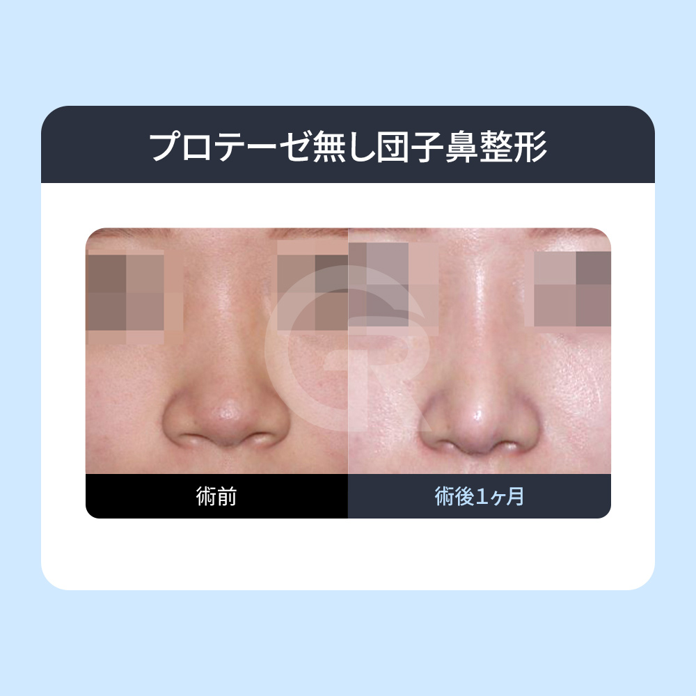 自家肋軟骨は、鼻再手術や構造的な鼻の矯正で強い支持力を発揮します。